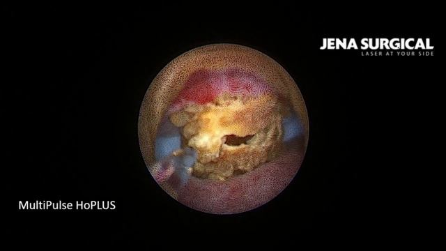 Holmium Lithotripsy Kidney Stone 1.5 Cm , 365 Fiber Using MultiPulse HoPLUS. Artem Gonyaev. M&Ch.