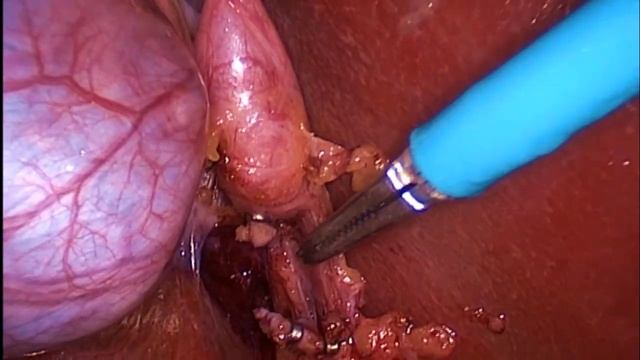 Lap Chole By Dr Muhammad Zarin