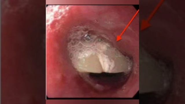 Endoscopic Removal Of Impacted Denture In The Esophagus #endoscopy #gastroenterologist #dysphagia