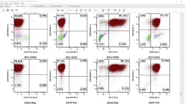 Flow Cytometry Interpretation In B-Lymphoblastic Leukemia/Lymphoma: Key Insights And Case Examples