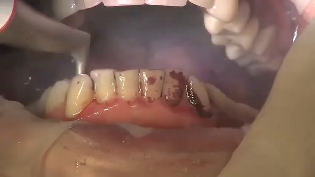 Guided Biofilm Therapy