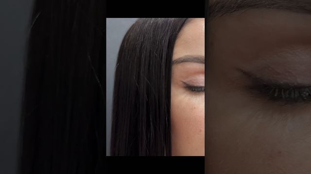 1 год после пластики век. Хирург Баков Вадим Сергеевич