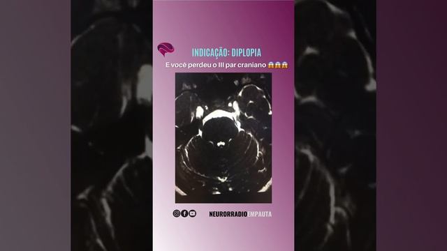 Pare De Perder O Nervo Trigêmeo E O Oculomotor No Seu Exame