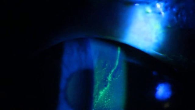 Herpes Simplex Keratitis with NaFl Staining - 24 hours after infection onset