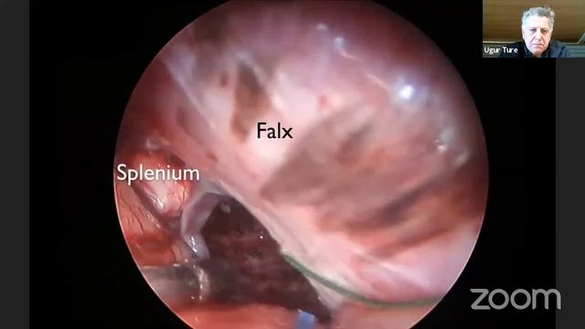 Juha's China Neurosurgery Grand Rounds April 23, 2021