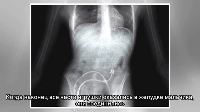 Самые жуткие предметы, которые когда-либо находили в человеческом желудке