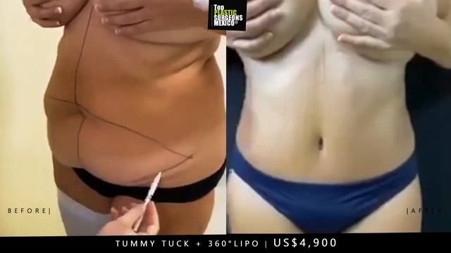 US$4,900 Tummy Tuck + 360°Lipo In Mexico | ✔️www.TopPlasticSurgeonsMexico.com