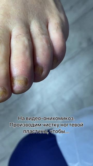 АФС-прорыв в мире подологии!