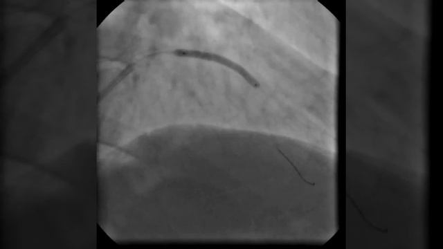 Имплантация стента 3 х 35 мм. в средний сегмент ПМЖВ.
