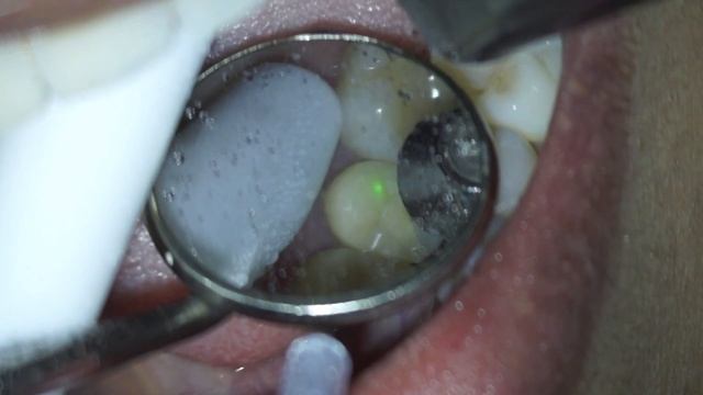 Fotona Lightwalker Laser Zirconia Ceramic Onlay Removal