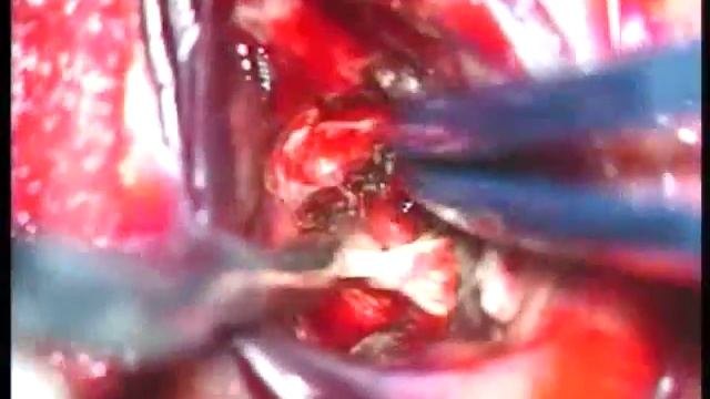 Total Removal Of Left Temporal AVM Martin-Spetzler Grade IV,