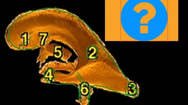 Third And 4th Ventricle