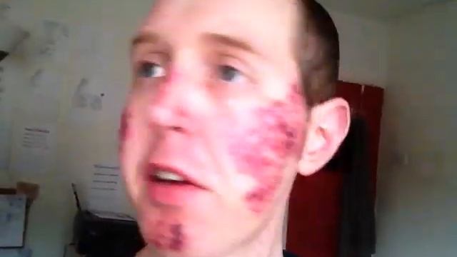 3rd Full Face Vbeam/Laser/PDL For Redness, PIE Skin Damage