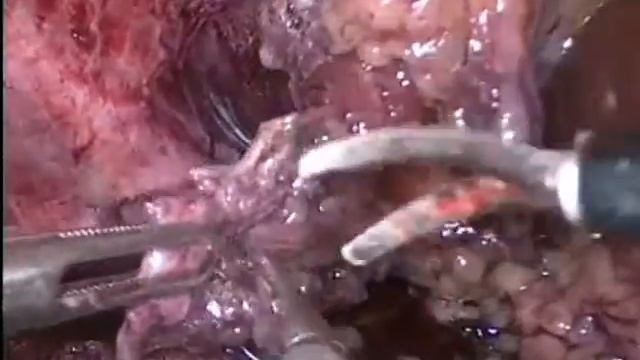 Laparoscopic Repair Pleural Injury During Rigth Lap Nephrectomy