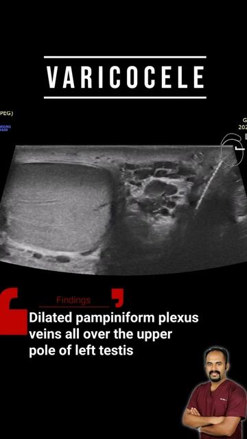 Varicocele - Ultrasound