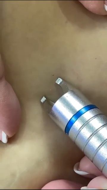 Диодный лазер для удаления сосудов