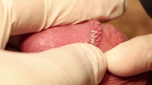 Dr. Groff Removes Pearly Penile Papules PPP With C02 Laser (ADULT CONTENT)