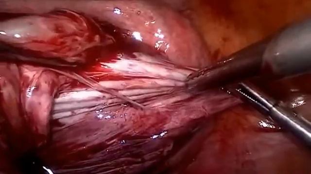 Bilateral Endometrioma Laparoscopic surgery with bare minimum hand instruments by Dr Bijoy Nayak
