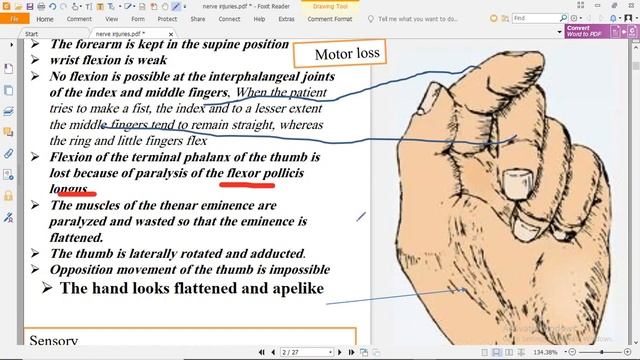 Anatomy Medical Students -  Lecture 17 -  Part 1 -  Median Nerve Injury