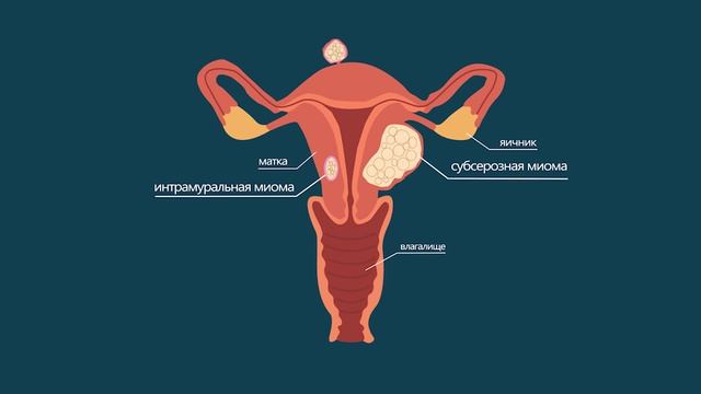 МИОМА матки |  | ПРИЧИНЫ | СИМПТОМЫ | одно из САМЫХ ЧАСТЫХ заболеваний у женщин