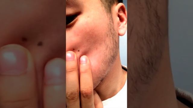 Minoxidil Asian Beard (week 4)