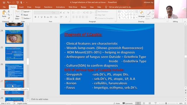 Fungal Skin Infections - Dr. Niji Sara Jacob
