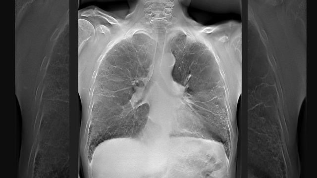МТЛ: томосинтез органов грудной клетки