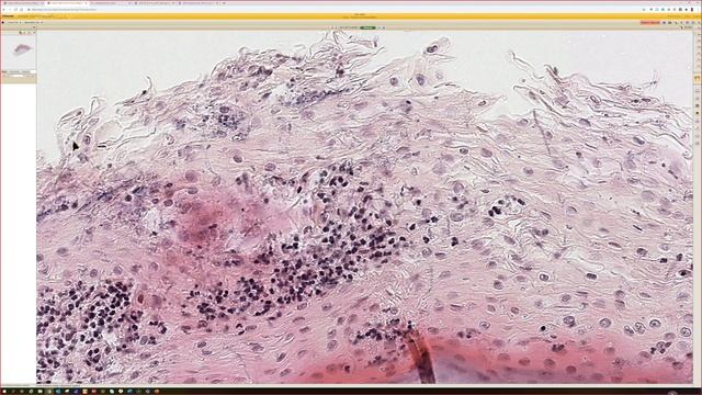 Candida Yeast Infection Under Microscope (Candidiasis) Dermatology Dermatopathology