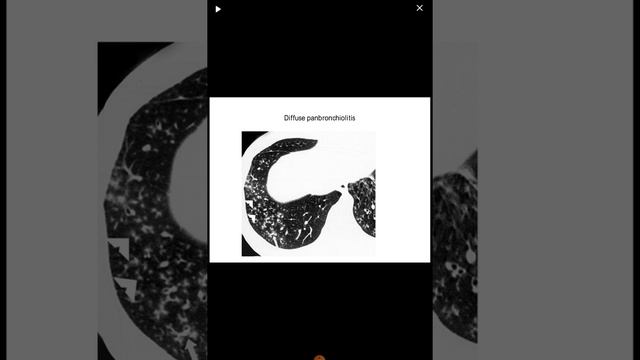 Lec No 10 Tree In Bud Pattern