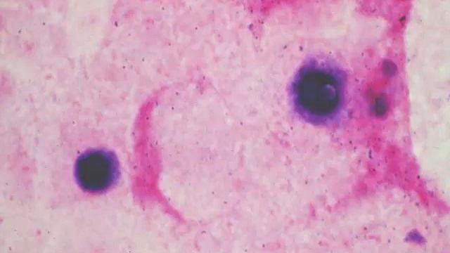 Clinical Mycology: Direct Examination Series: Crytococcus [Hot Topic]