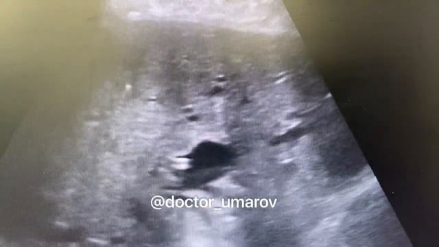 Билиарные гамартомы - гиперэхогенные включения с эффектом «хвоста кометы» по ходу желчных протоков