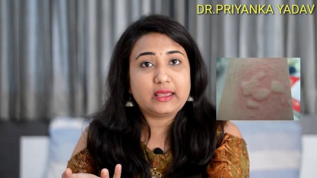 पित्ती ( URTICARIA ) जड़ से कैसे मिटाये | URTICARIA (छपाकि) Homeopathic Treatment