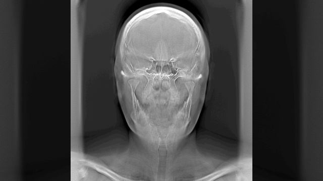 МТЛ: Томосинтез головы и шеи