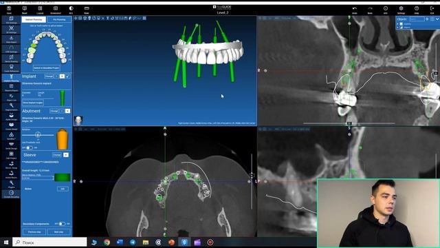Обучение хирургическим шаблонам в программе RealGuide. Шаблоны при множественном удалении зубов