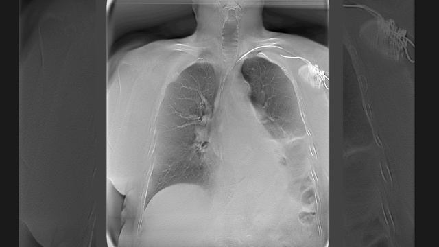 МТЛ: Томосинтез с MAR