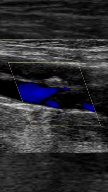 DVT US (B) (Ahuja AT Et Al; 2017) Book: Essential Radiology