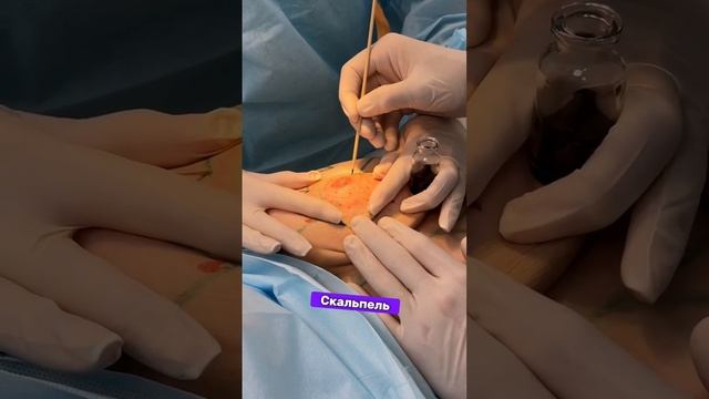 Как выполняется редукционная маммопластика? Рассказываю от А до Я!