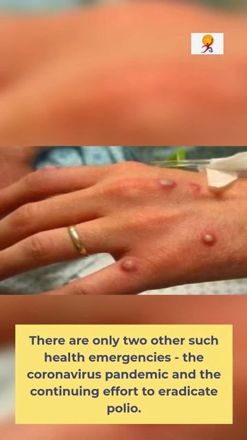 WHO Declared Monkeypox A Global Health Emergency | #shorts