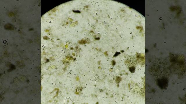 Strongyloides Stercoralis In Stool  Specimen On 10x