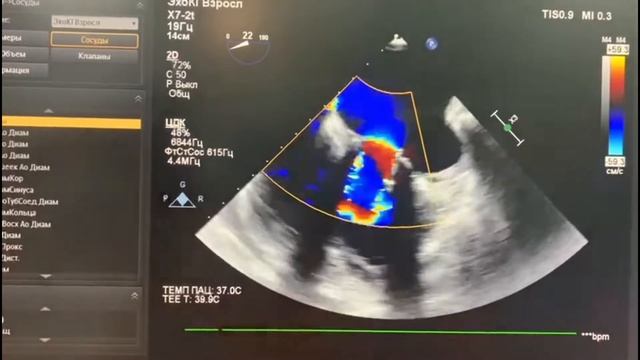 67. Репротезирование МК.