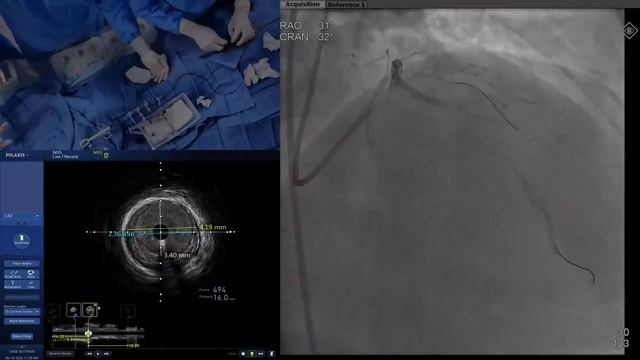 Live Case 3 - IVUS Guided Mini-Crush Of LAD/D1 Bifurcation
