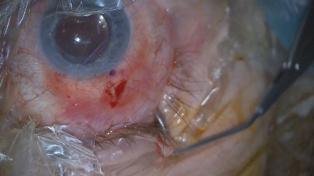 03 Preserflo New Glaucoma Trainee, Severe IFIS Causes Implant To Catch Iris 3x 20220927 152652