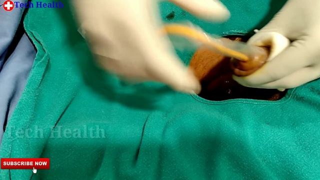 Male Catheter Insertion Procedure In Hindi ||Foley Catheter Insertion Trick | How To Insert Cathete