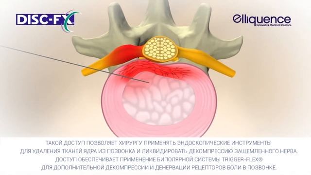 Чрескожная радиоволновая Disc-FX дискэктомия, поясничный уровень.