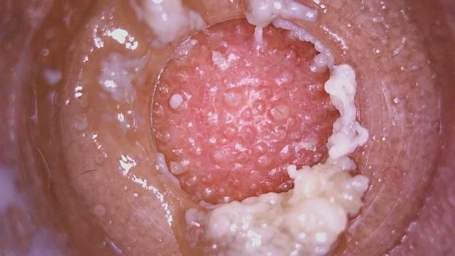 Pore Vacuum Removal 23.8 #viral #viralvideo #shortsvideo #satisfying #shorts #shortvideo#pores #acn