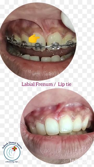 Frenectomy For Midline Diastema #Frenectomy #diastema #dentist #teethstraightening #oralsurgeon
