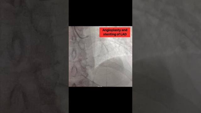 Mechanical Recanalization And Dilatation Of Coronary Arteries In The Acute Stage Of MI. Widowmaker.