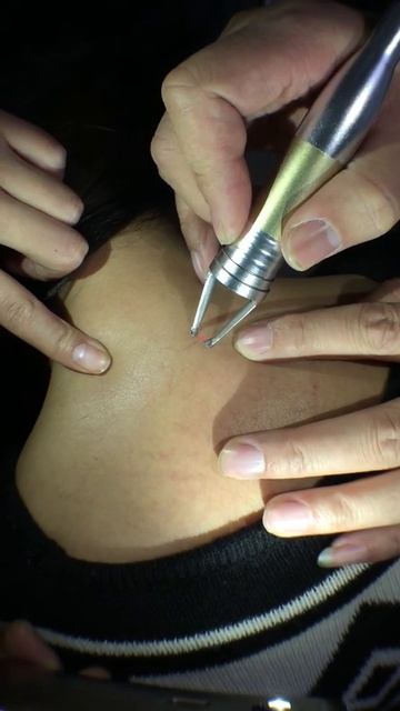 Vascular Removal