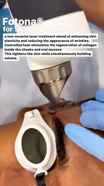 Revolutionary Fotona Skin Tightening: Boost Elasticity & Reduce Wrinkles In Dubai