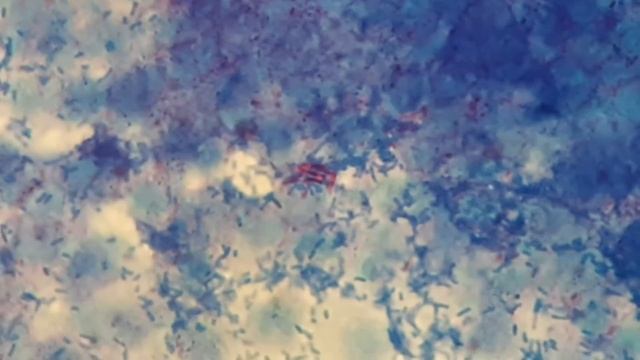 Acid Fast Bacilli In Ziehl-Neelsen Staining Of Urine